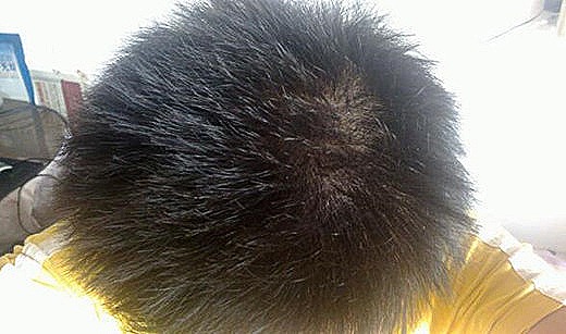毛发稀少的八字特征