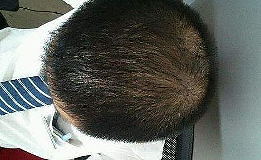 毛发稀少的八字特征
