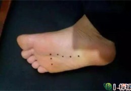 脚上有黑痣好吗