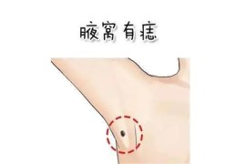 腋下有痣好吗