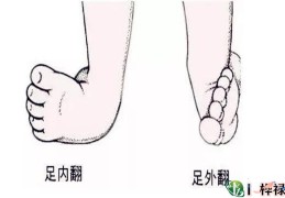 腿部畸形命好吗